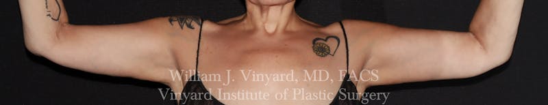 Post Weight Loss Makeovers Before & After Gallery - Patient 712338 - Image 12