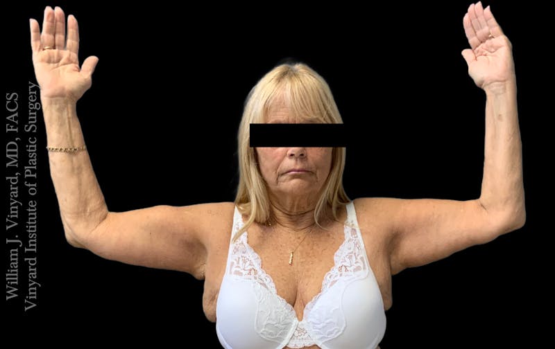 Post Weight Loss Makeovers Before & After Gallery - Patient 238988 - Image 8