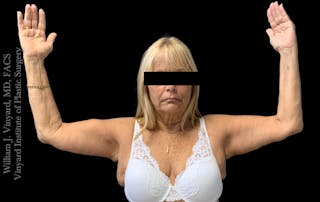 Post Weight Loss Makeovers Before & After Gallery - Patient 238988 - Image 8