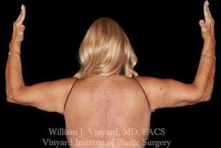 Post Weight Loss Makeovers Before & After Gallery - Patient 238988 - Image 10