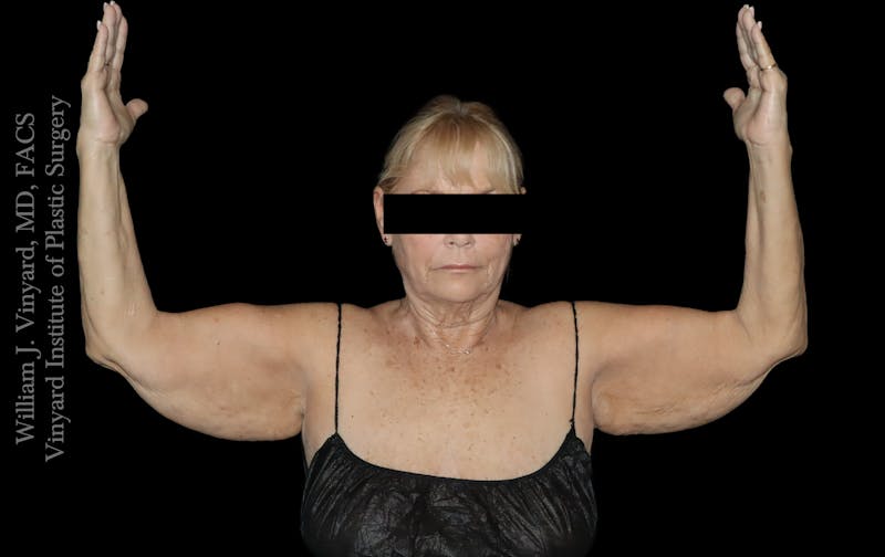 Post Weight Loss Makeovers Before & After Gallery - Patient 238988 - Image 7