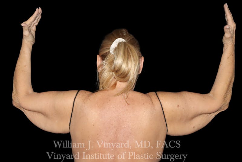 Post Weight Loss Makeovers Before & After Gallery - Patient 238988 - Image 9