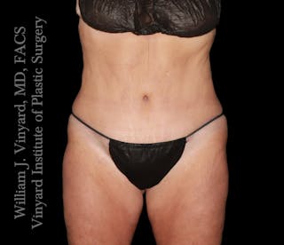 Tummy Tuck Before & After Gallery - Patient 265713 - Image 2