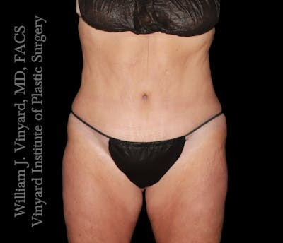 Tummy Tuck Before & After Gallery - Patient 265713 - Image 2