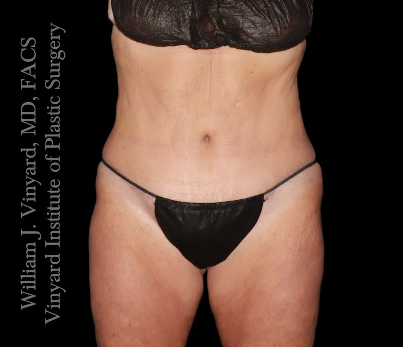 Tummy Tuck Before & After Gallery - Patient 265713 - Image 2