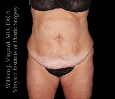Tummy Tuck Before & After Gallery - Patient 265713 - Image 1