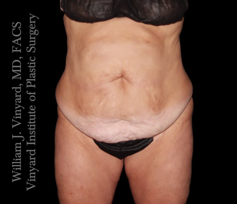 Tummy Tuck Before & After Gallery - Patient 265713 - Image 1