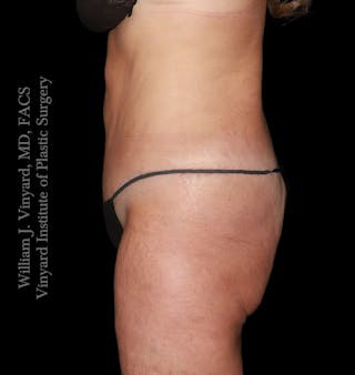 Tummy Tuck Before & After Gallery - Patient 265713 - Image 6