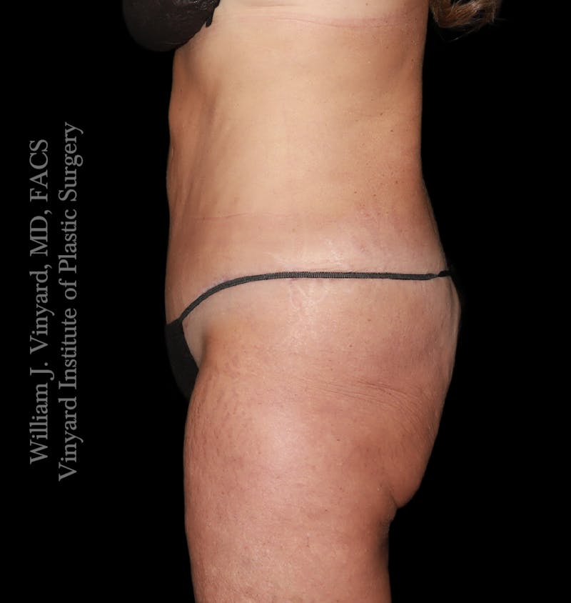 Tummy Tuck Before & After Gallery - Patient 265713 - Image 6