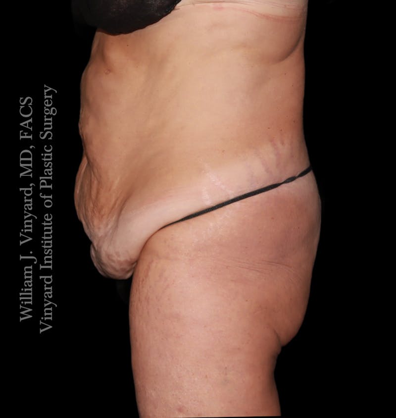 Tummy Tuck Before & After Gallery - Patient 265713 - Image 5