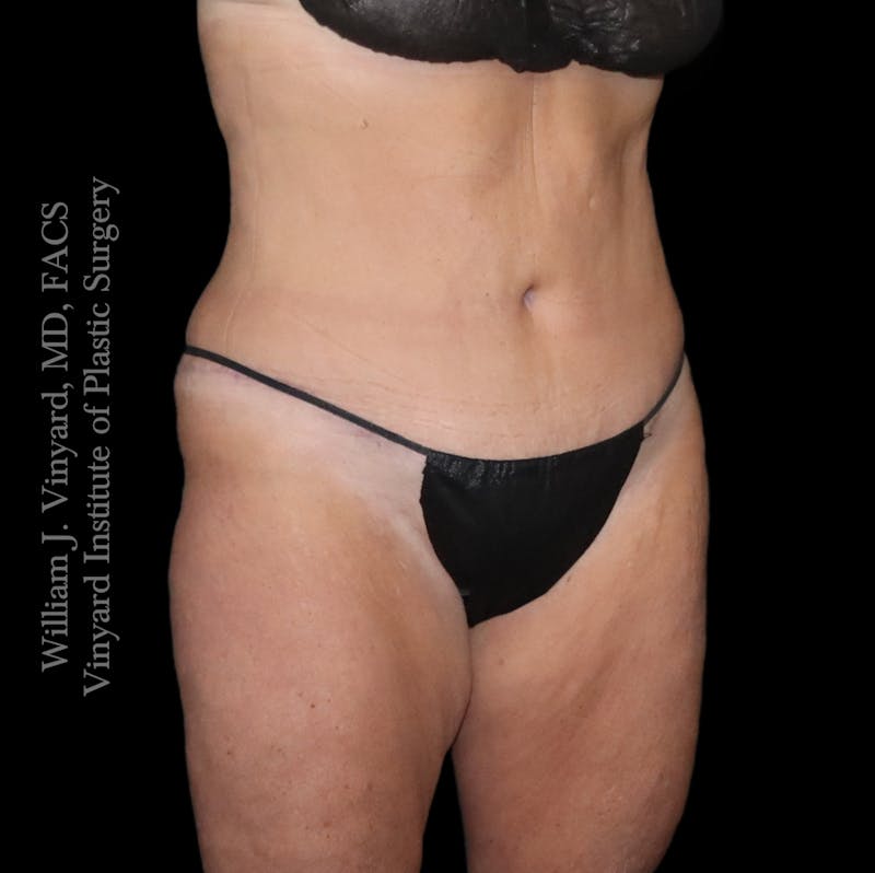 Tummy Tuck Before & After Gallery - Patient 265713 - Image 4