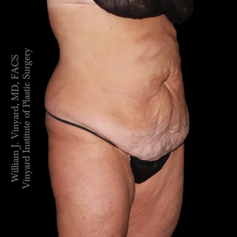 Tummy Tuck Before & After Gallery - Patient 265713 - Image 3