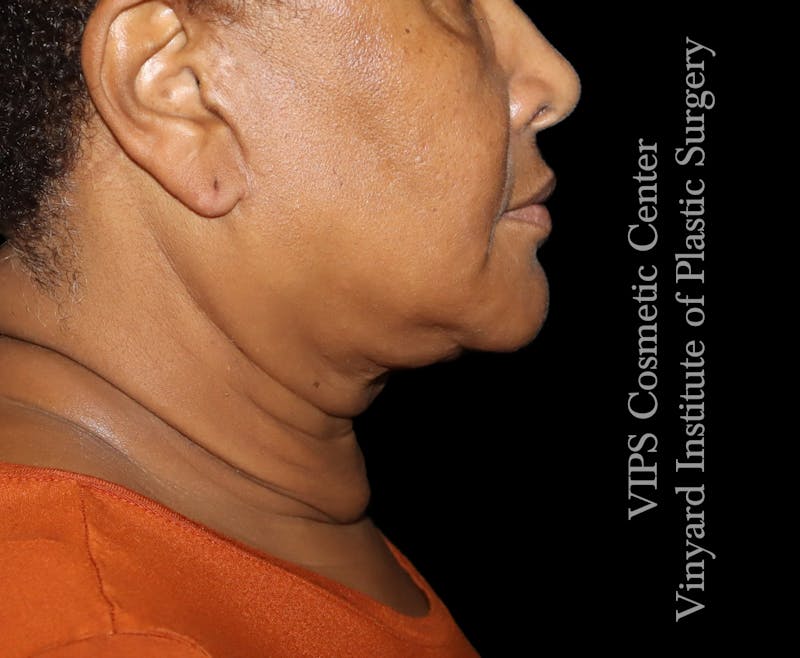 Morpheus8 RF Microneedling Before & After Gallery - Patient 298044 - Image 1