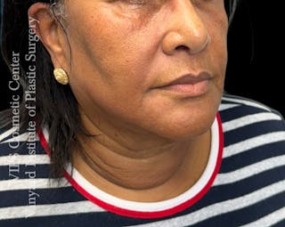 Morpheus8 RF Microneedling Before & After Gallery - Patient 298044 - Image 4