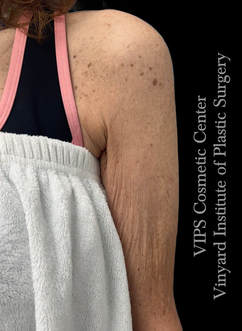 Morpheus8 BODY RF Microneedling Before & After Gallery - Patient 311110 - Image 3