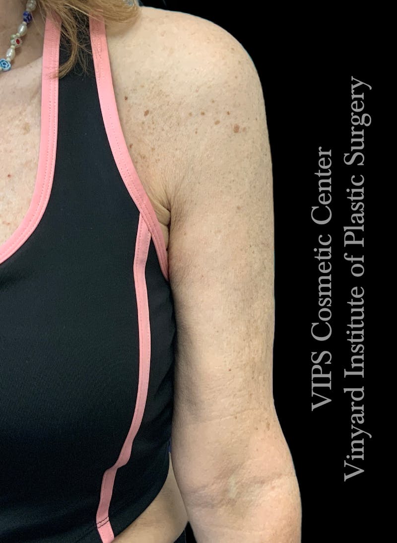 Morpheus8 BODY RF Microneedling Before & After Gallery - Patient 311110 - Image 4