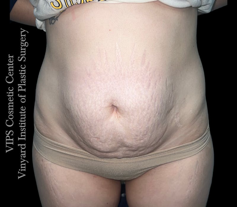 Morpheus8 BODY RF Microneedling Before & After Gallery - Patient 346933 - Image 1