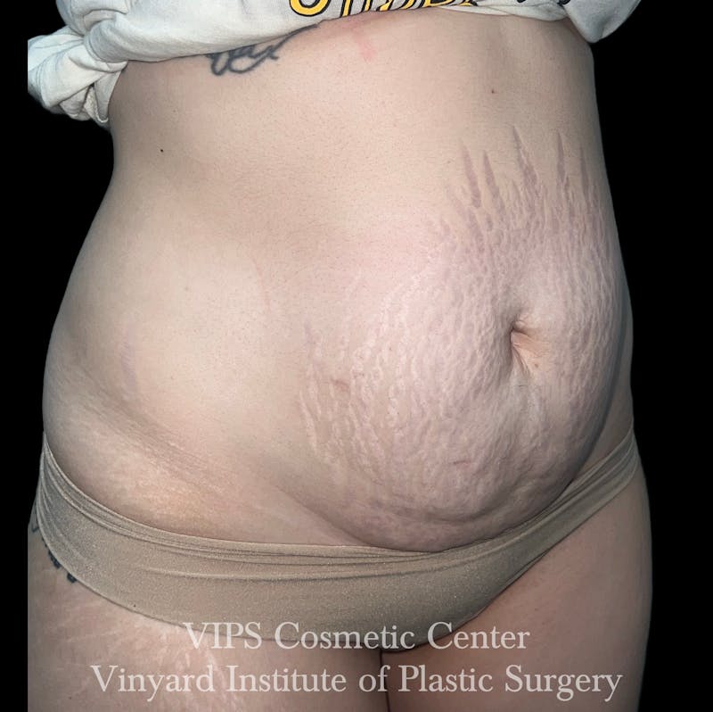 Morpheus8 BODY RF Microneedling Before & After Gallery - Patient 346933 - Image 3