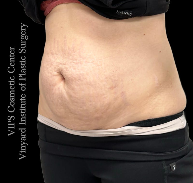 Morpheus8 BODY RF Microneedling Before & After Gallery - Patient 346933 - Image 6