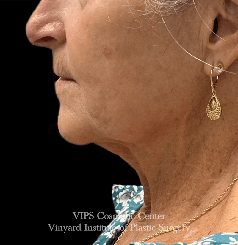 Deep CO2 Laser Skin Resurfacing Before & After Gallery - Patient 145556 - Image 5