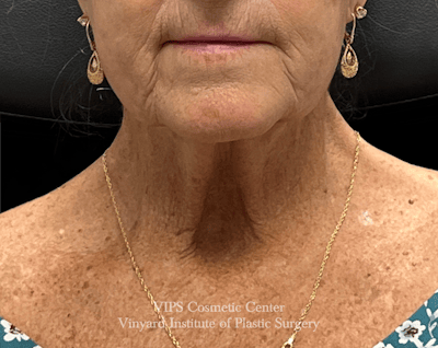 Deep CO2 Laser Skin Resurfacing Before & After Gallery - Patient 145556 - Image 1