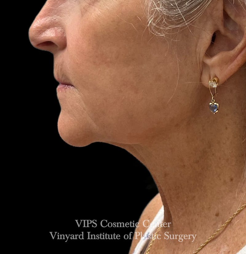 Deep CO2 Laser Skin Resurfacing Before & After Gallery - Patient 145556 - Image 6
