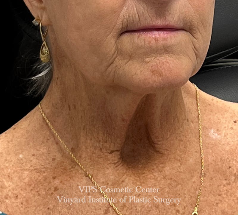 Deep CO2 Laser Skin Resurfacing Before & After Gallery - Patient 145556 - Image 3