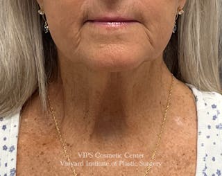 Deep CO2 Laser Skin Resurfacing Before & After Gallery - Patient 145556 - Image 2