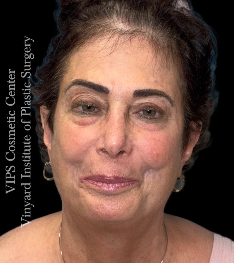 Elluminate Advanced Photofacial w/IPL Before & After Gallery - Patient 471273 - Image 2