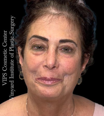 Deep CO2 Laser Skin Resurfacing Before & After Gallery - Patient 193338 - Image 2