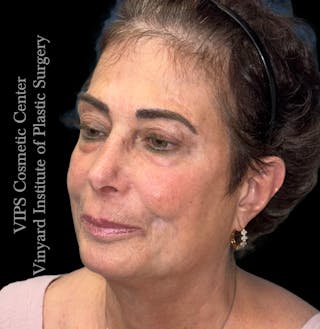 Elluminate Advanced Photofacial w/IPL Before & After Gallery - Patient 471273 - Image 4