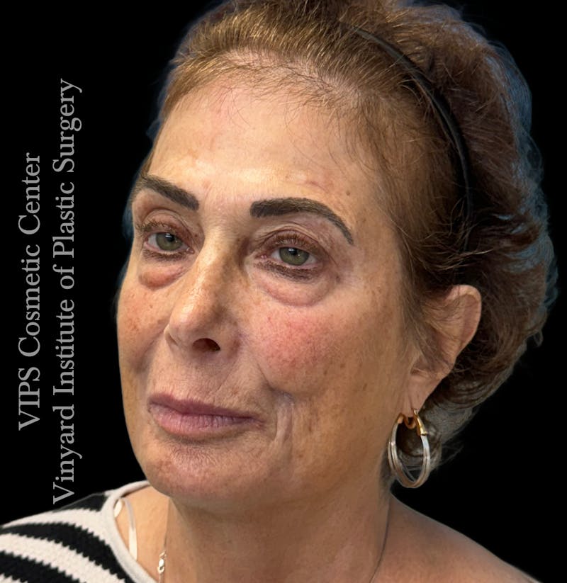 Elluminate Advanced Photofacial w/IPL Before & After Gallery - Patient 471273 - Image 3