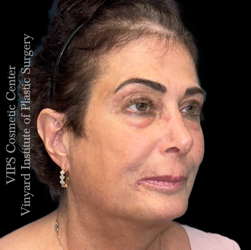 Elluminate Advanced Photofacial w/IPL Before & After Gallery - Patient 471273 - Image 6