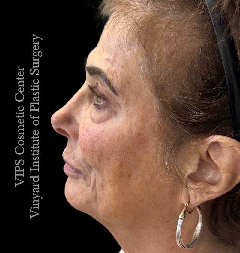 Elluminate Advanced Photofacial w/IPL Before & After Gallery - Patient 471273 - Image 7