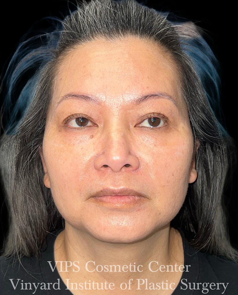 CoolPeel CO2 Laser Skin Resurfacing Before & After Gallery - Patient 315472 - Image 2