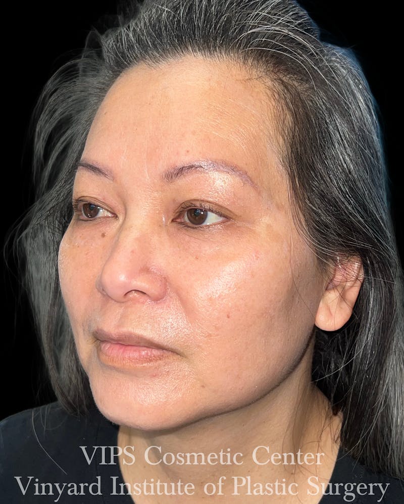 CoolPeel CO2 Laser Skin Resurfacing Before & After Gallery - Patient 315472 - Image 4