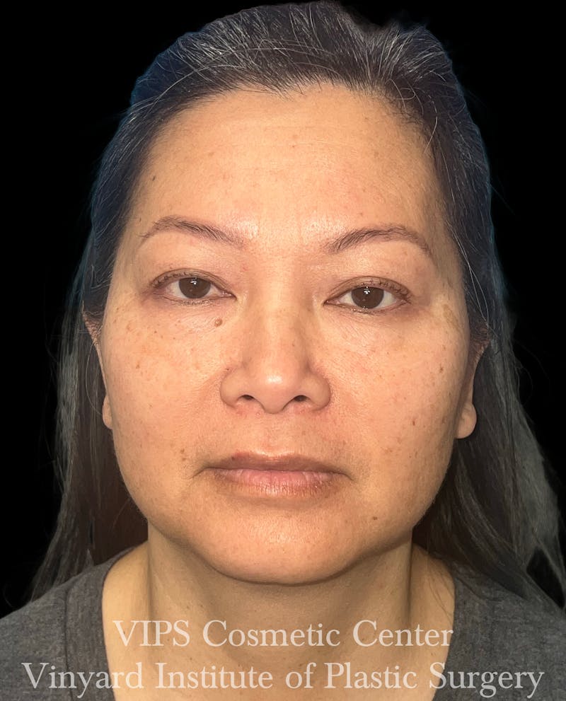 CoolPeel CO2 Laser Skin Resurfacing Before & After Gallery - Patient 315472 - Image 1