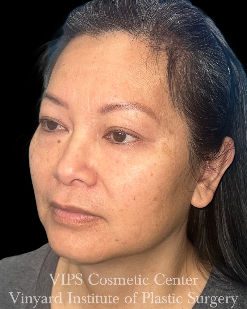CoolPeel CO2 Laser Skin Resurfacing Before & After Gallery - Patient 315472 - Image 3