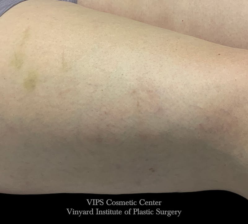 Laser Vein Removal Before & After Gallery - Patient 197491 - Image 2