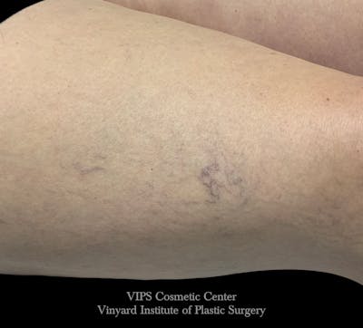 Laser Vein Removal Before & After Gallery - Patient 197491 - Image 1