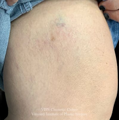Laser Vein Removal Before & After Gallery - Patient 103502 - Image 2