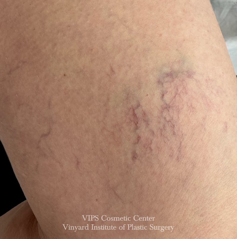 Laser Vein Removal Before & After Gallery - Patient 103502 - Image 1