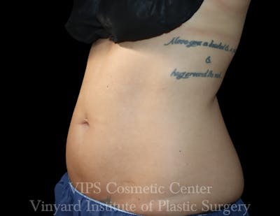 Coolsculpting ELITE Before & After Gallery - Patient 171436679 - Image 1