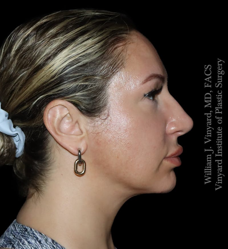FACEtite Before & After Gallery - Patient 171454988 - Image 4