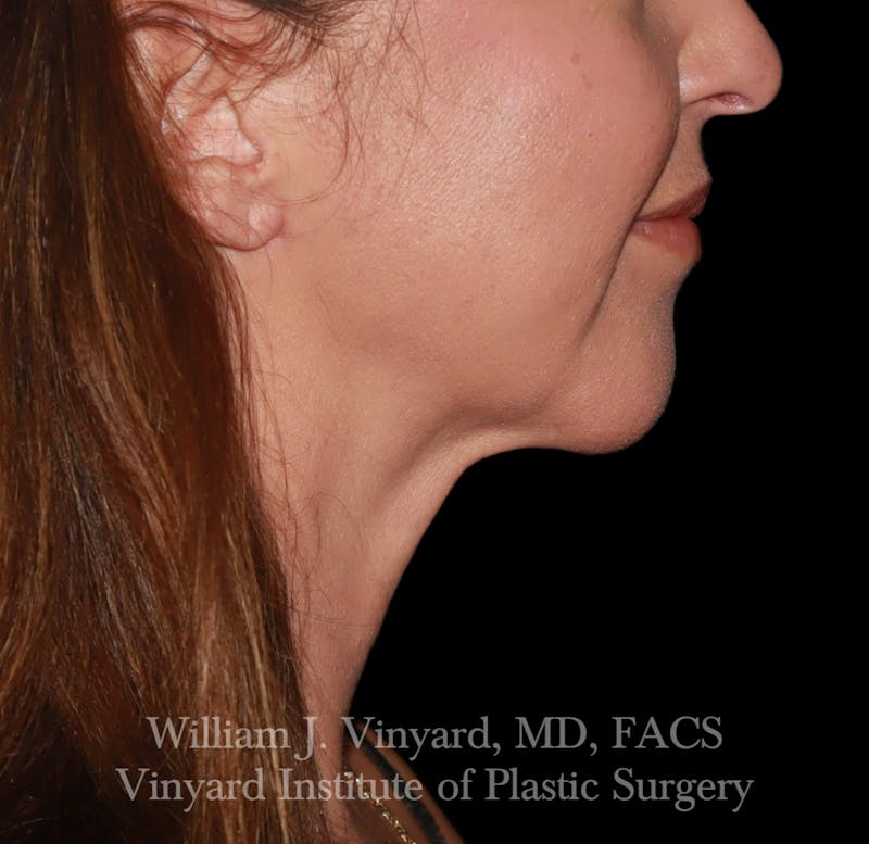 FACEtite Before & After Gallery - Patient 352050 - Image 4