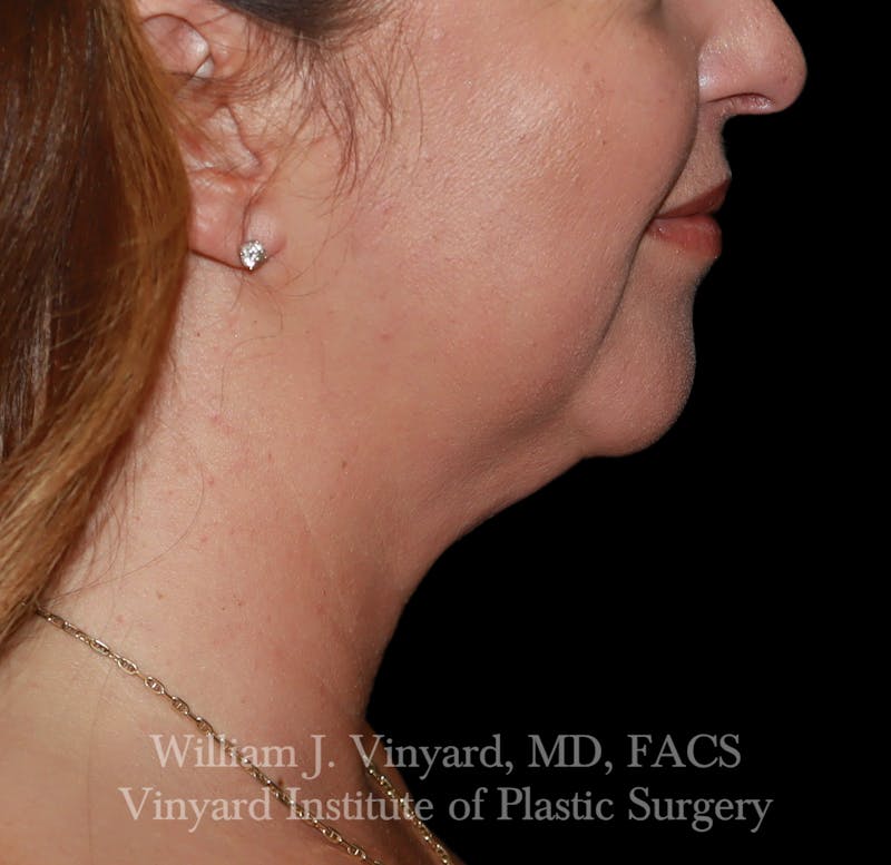 FACEtite Before & After Gallery - Patient 352050 - Image 3