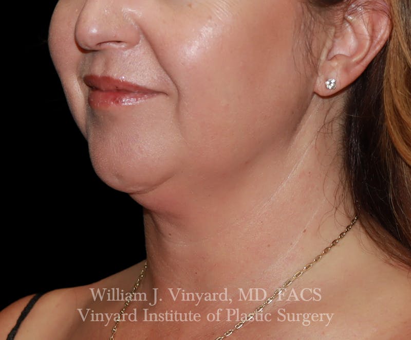 FACEtite Before & After Gallery - Patient 352050 - Image 5