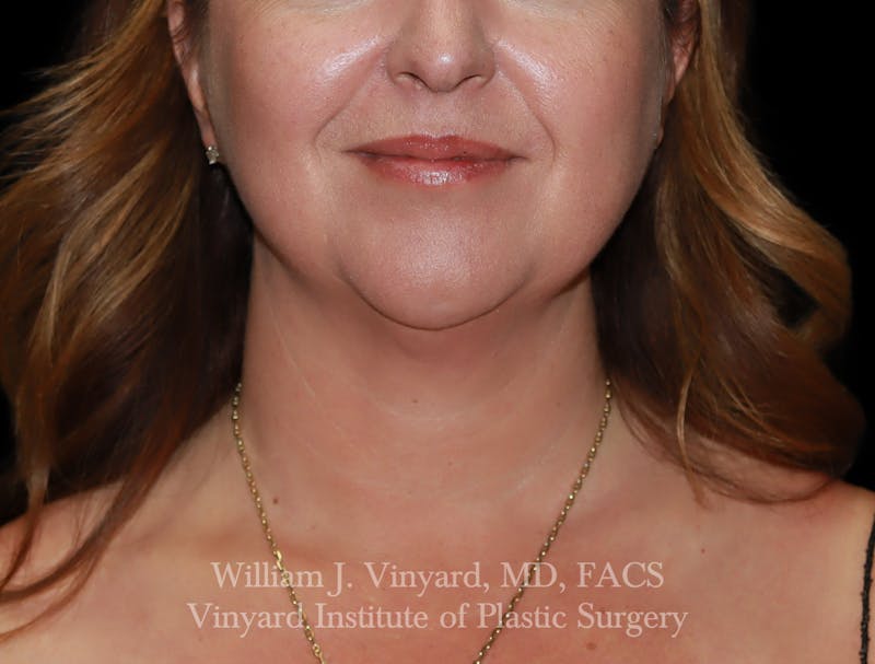 FACEtite Before & After Gallery - Patient 352050 - Image 1