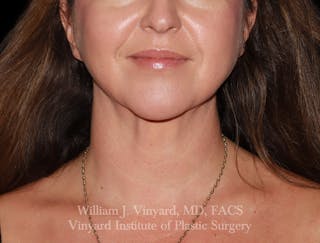FACEtite Before & After Gallery - Patient 352050 - Image 2