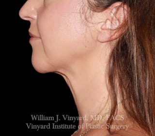 FACEtite Before & After Gallery - Patient 352050 - Image 8